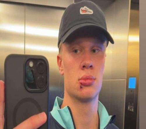 哈兰德晒下嘴唇受伤照：刚被车门夹了，缝了3针